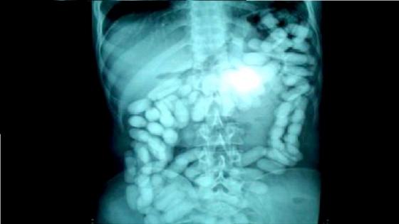 الدار البيضاء…حجز 1270 غراما من الكوكايين لدى مواطن مالي حاول تهريبها داخل أمعائه