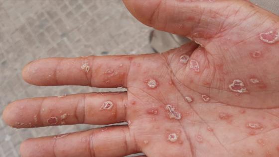 سبل علاج مرضى الصدفية في غياب التغطية الصحية