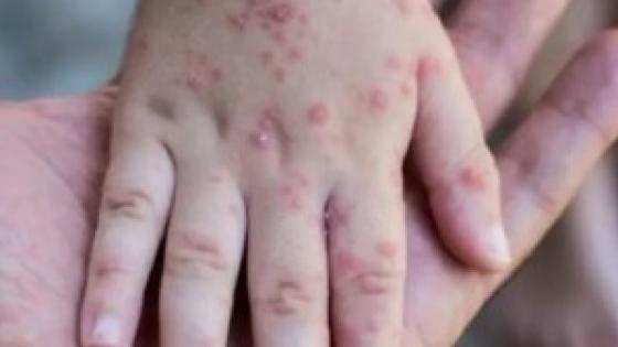 السلطات الصحية الإسبانية تعلن تسجيل 2835 إصابة بجدري القرود